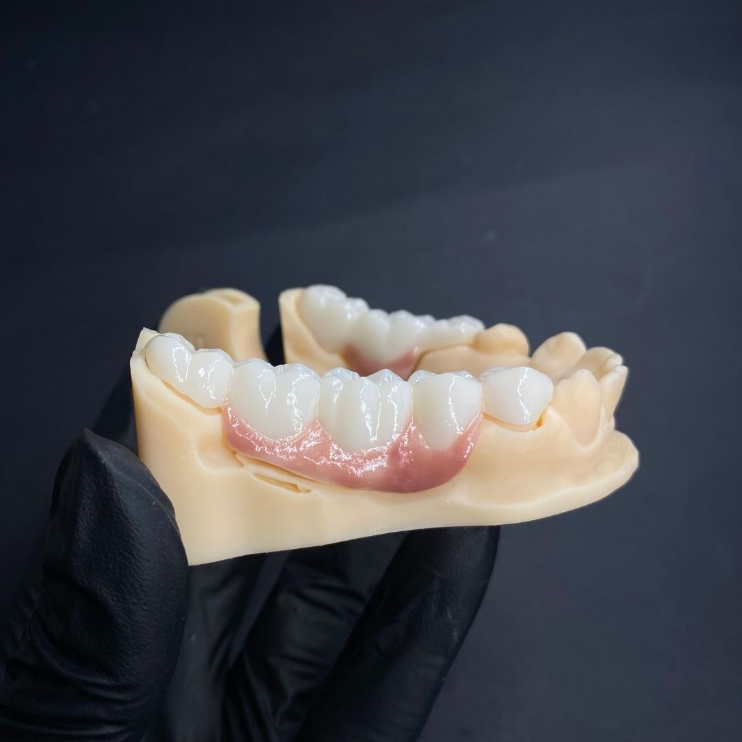Corona en zirconio monolítico - Goaligner